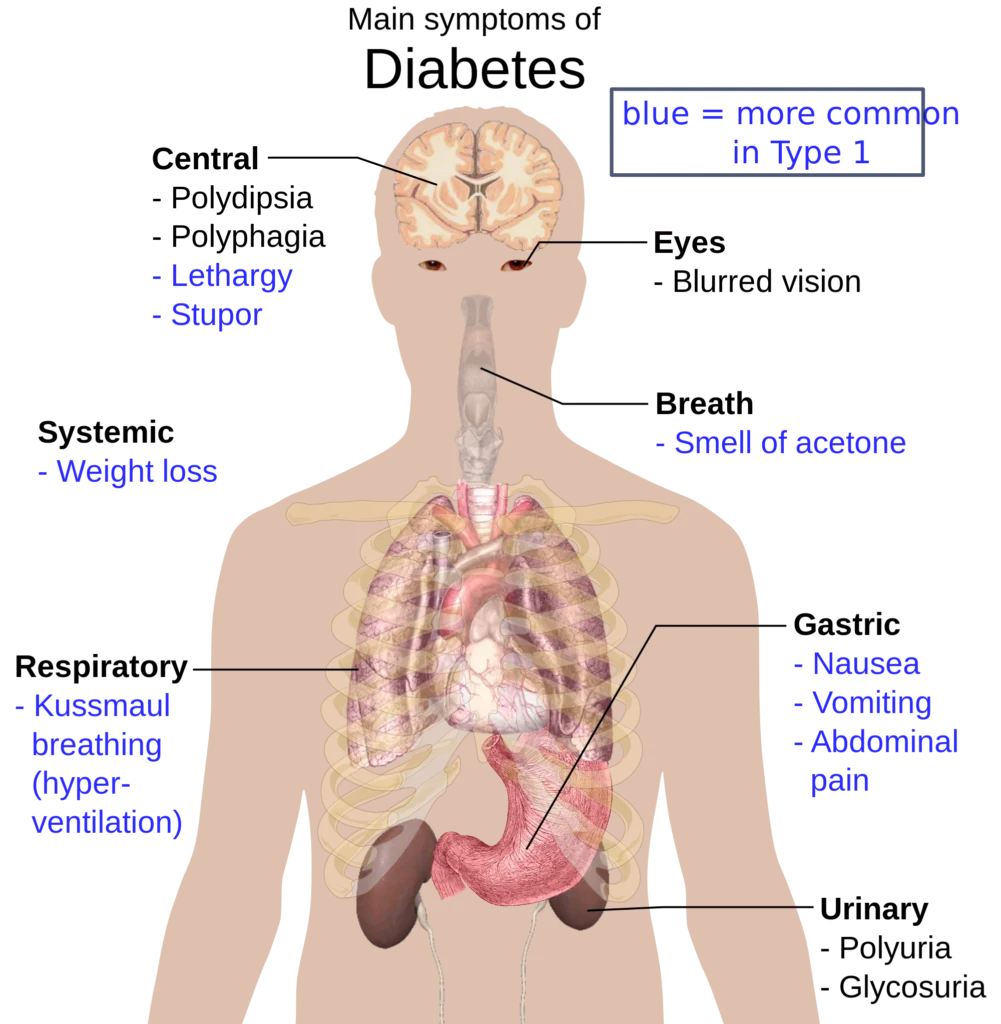 Diagram showing symptoms of diabetic ketoacidosis including nausea, Kussmaul breathing, weight loss, and acetone breath