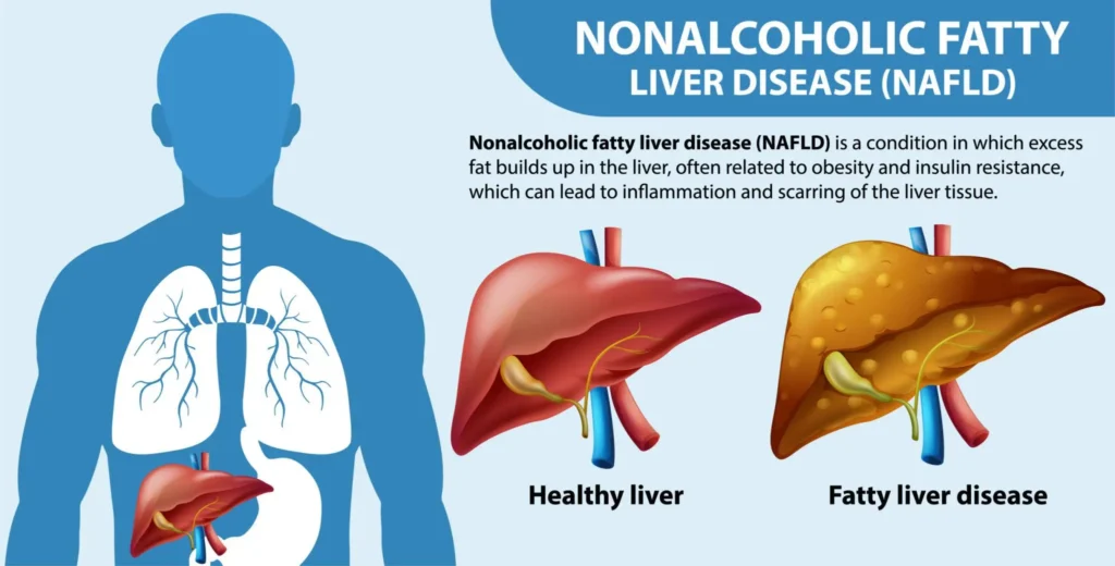 Fatty liver disease (NAFLD) with comparison between a healthy liver and a fatty liver with fat accumulation.