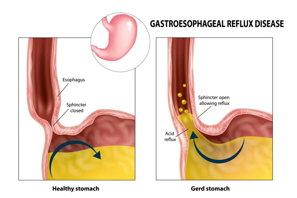 GERD acid reflux diagram comparing healthy stomach and gastroesophageal reflux disease with lower esophageal sphincter dysfunction