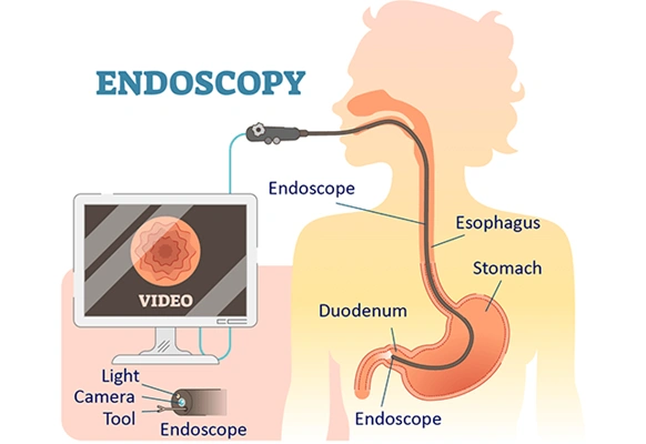“Upper GI endoscopy procedure showing esophagus, stomach and duodenum for GERD diagnosis”