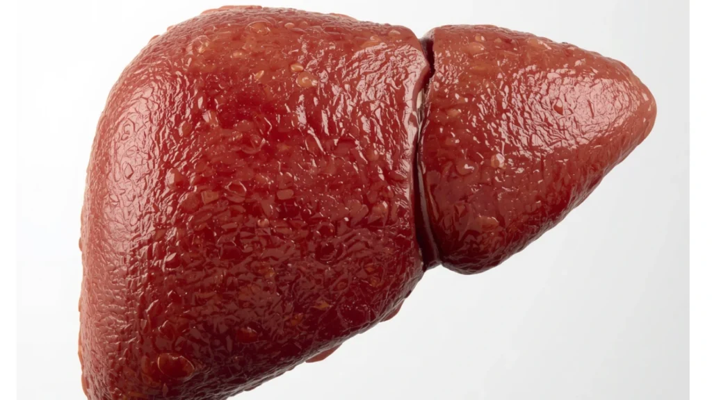 Fatty liver disease showing fat accumulation in liver tissue (ICD-10 code reference)