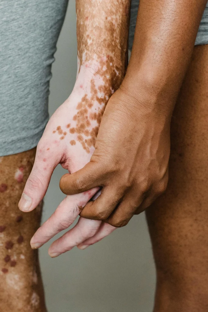 Is psoriasis contagious? Image showing skin condition with human touch to explain psoriasis is not contagious