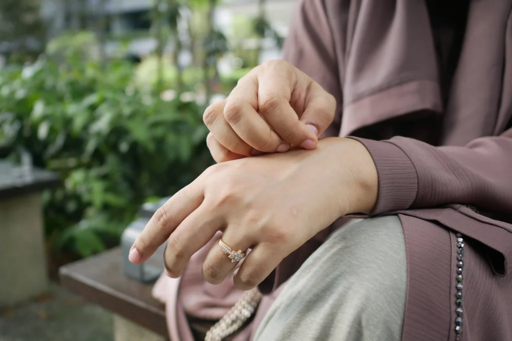 Person scratching an itchy hand due to dry skin (xerosis), a common condition that causes dryness and irritation.